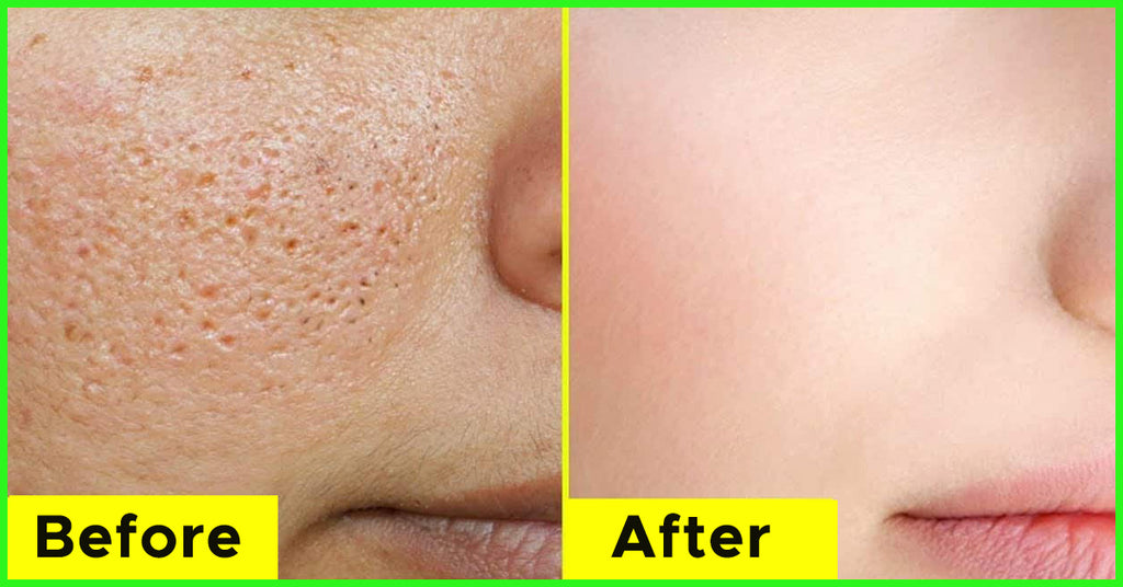 What Is The Solution For Open Pores On Skin? Effective Home Remedies - AllDayHealthy